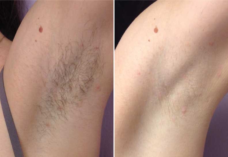 Laser-Hair-Removal-EvolvMD-Before-After-1